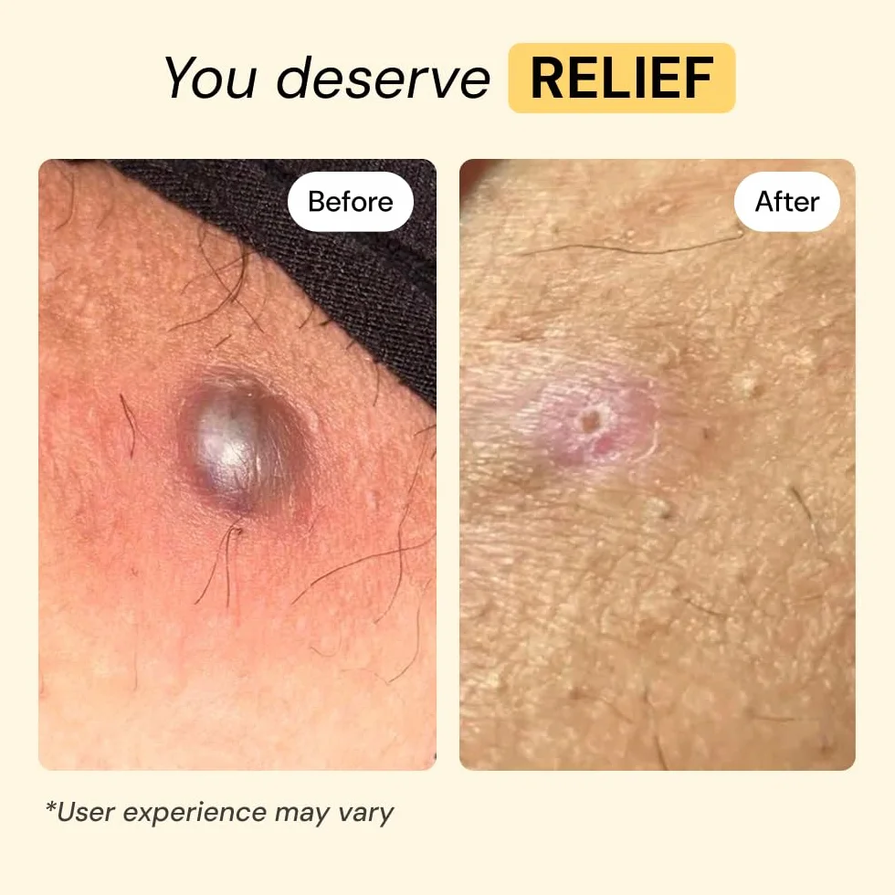 MyMagicHealer Universal Flare Care - Pomada extractora para HS, forúnculos, quistes, hemorroides, quiste pilonidal, absceso, antirozaduras, cuidado de heridas, alivio para el picor de piel con