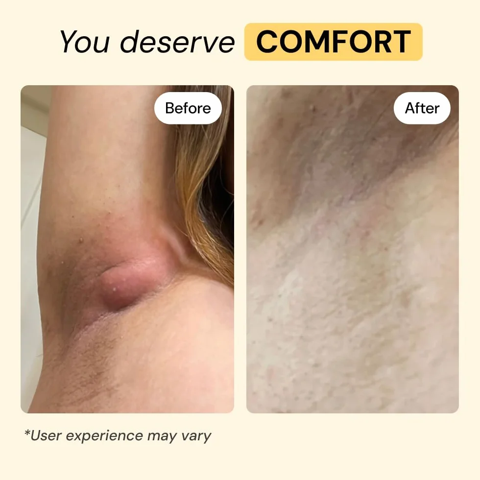 MyMagicHealer Universal Flare Care - Pomada extractora para HS, forúnculos, quistes, hemorroides, quiste pilonidal, absceso, antirozaduras, cuidado de heridas, alivio para el picor de piel con