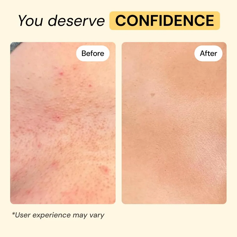 MyMagicHealer Universal Flare Care - Pomada extractora para HS, forúnculos, quistes, hemorroides, quiste pilonidal, absceso, antirozaduras, cuidado de heridas, alivio para el picor de piel con