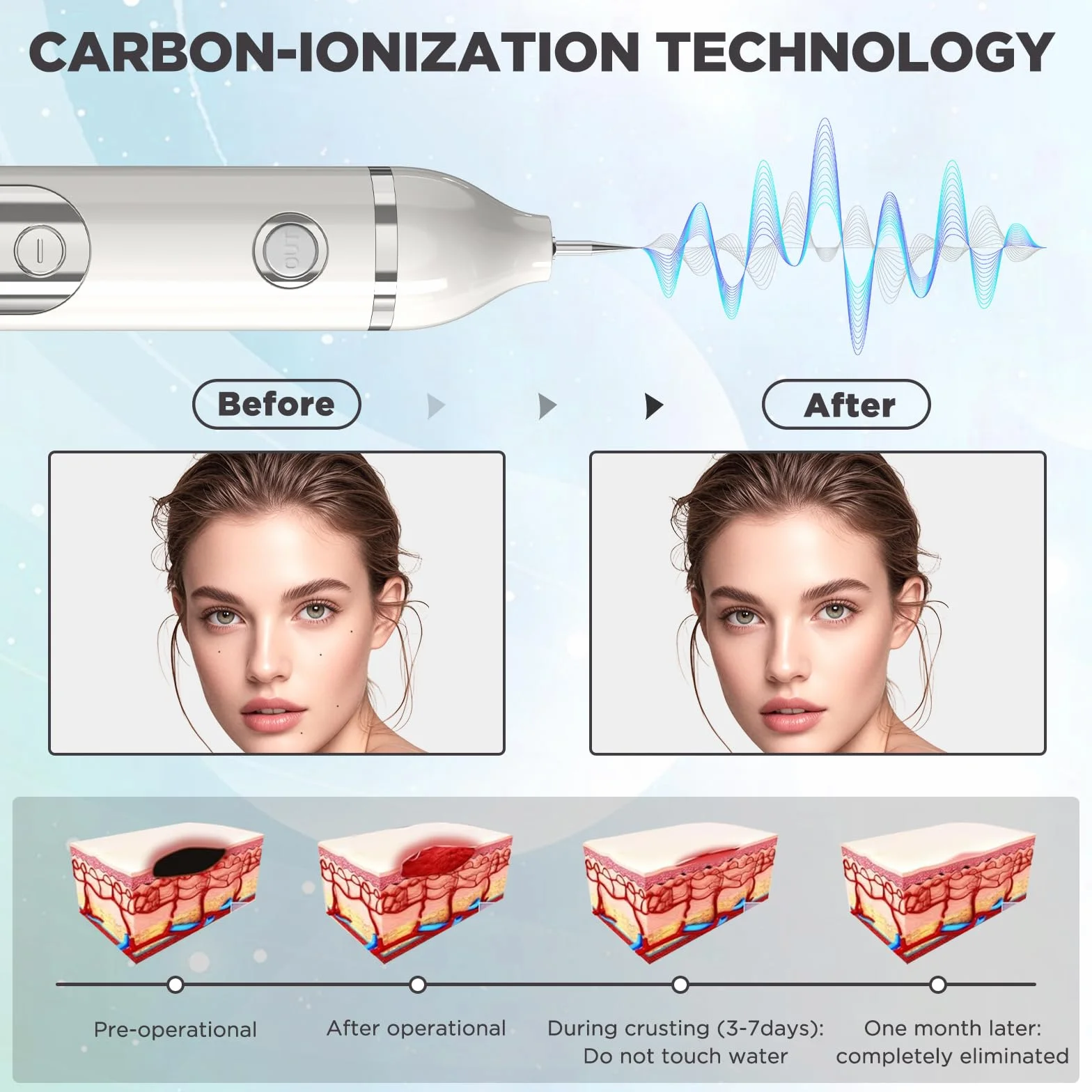 Lápiz Eliminar Verrugas Plasma 19 Niveles Intensidad Luz LCD Aguja Reemplazable Rostro Cuerpo